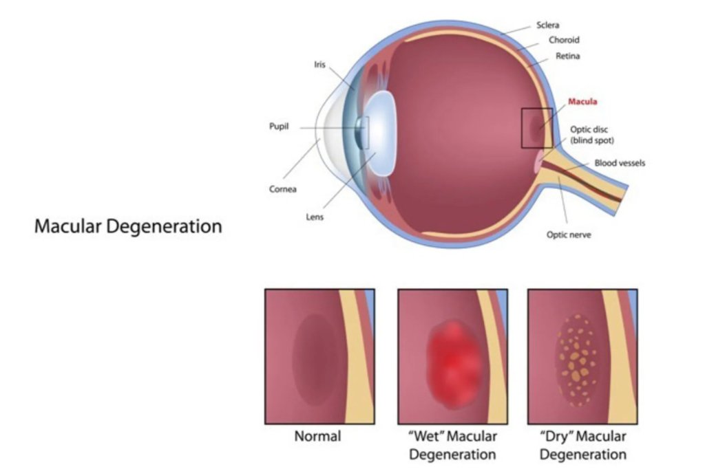 Macular Degeneration