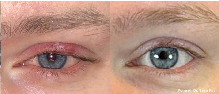 Before and after RF therapy — eyelid inflammation reduction