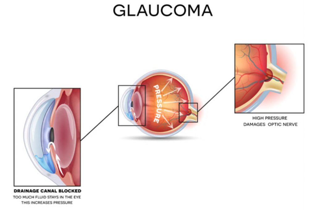 Glaucoma