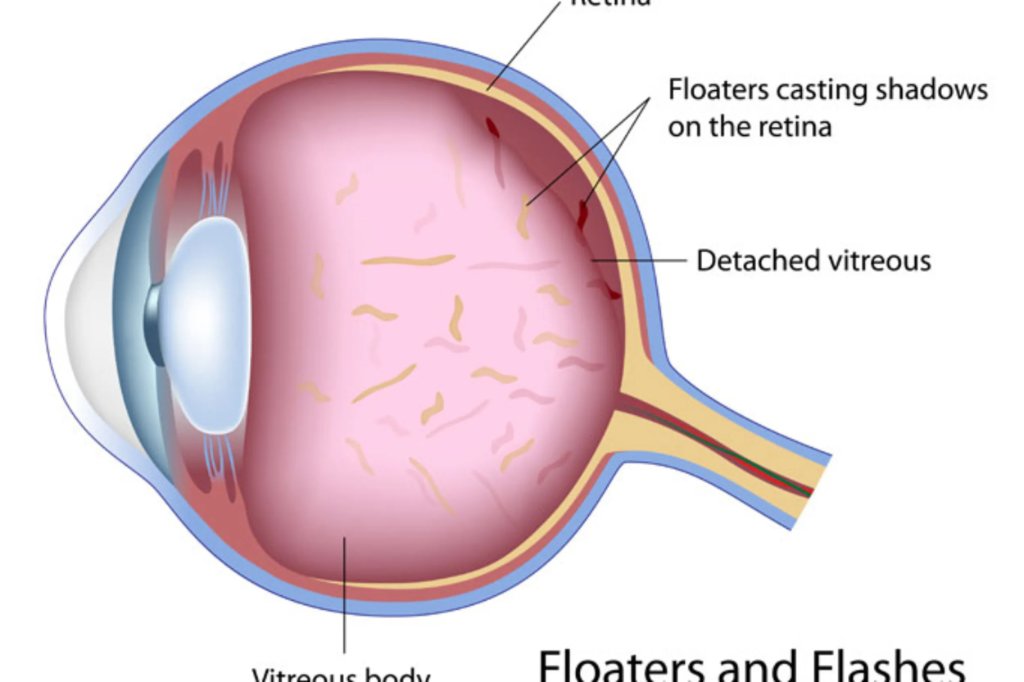 Floaters and Flashes