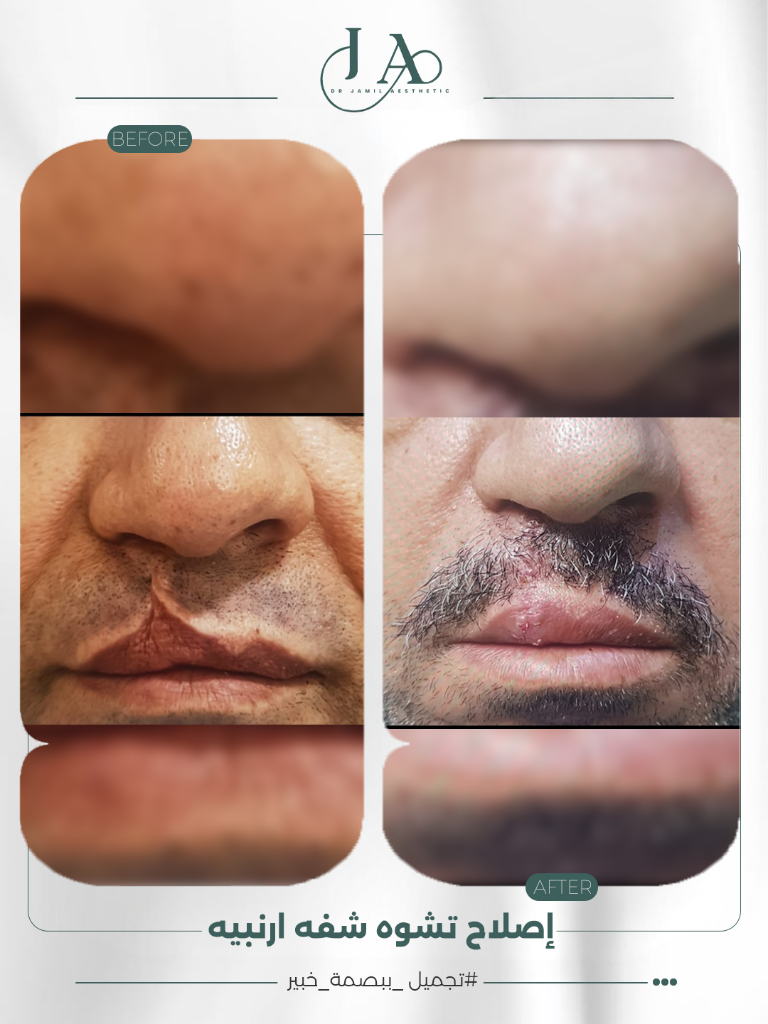 Before & After — Cleft Lip Repair