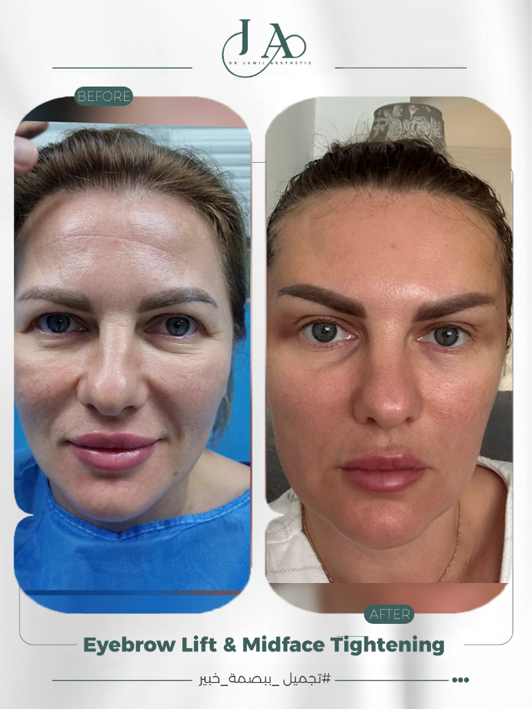 Before & After — Eyebrow Lift & Midface — Case 2