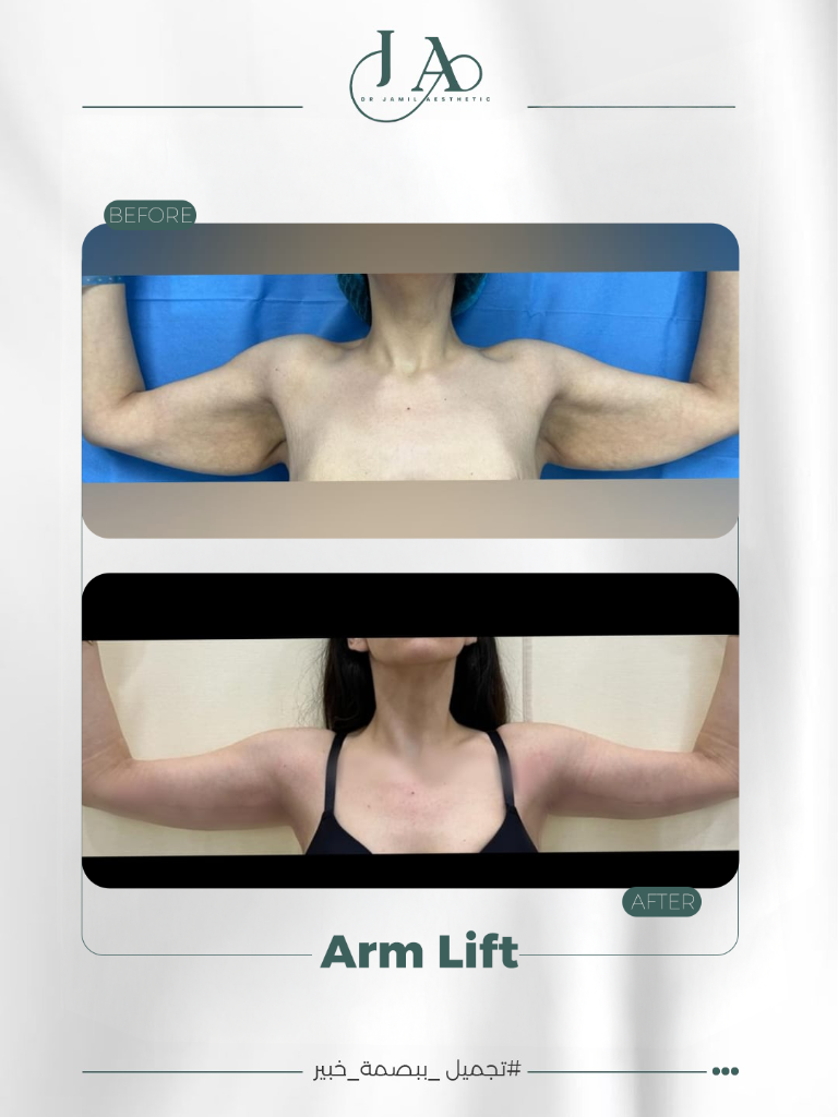 Arm Lift — Brachioplasty