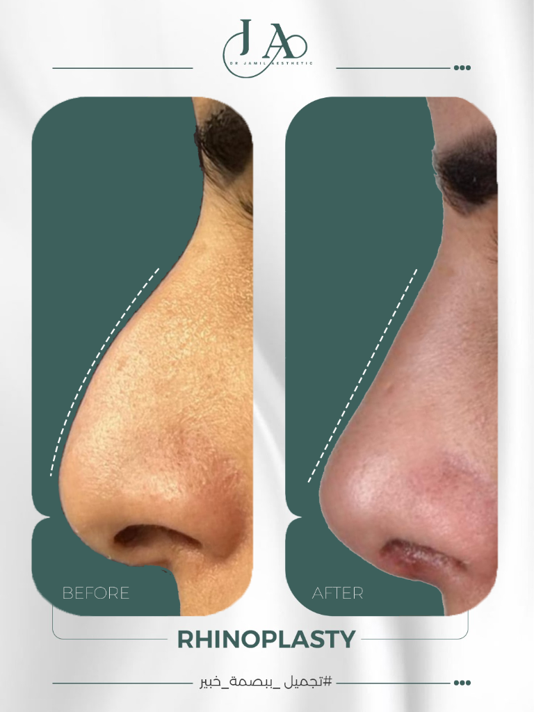Rhinoplasty — Frontal Case 2