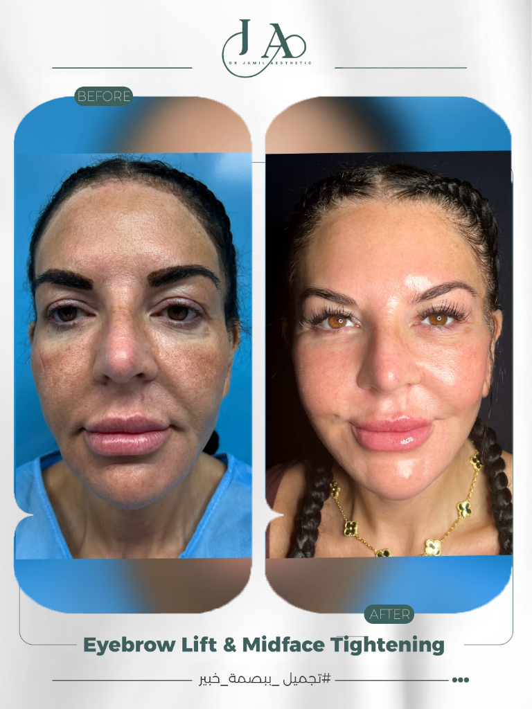 Eyebrow Lift & Midface Tightening