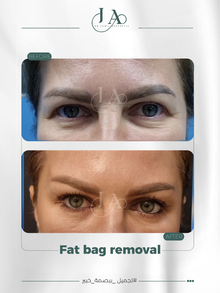 Before & After — Fat Bag Removal — Periorbital Rejuvenation