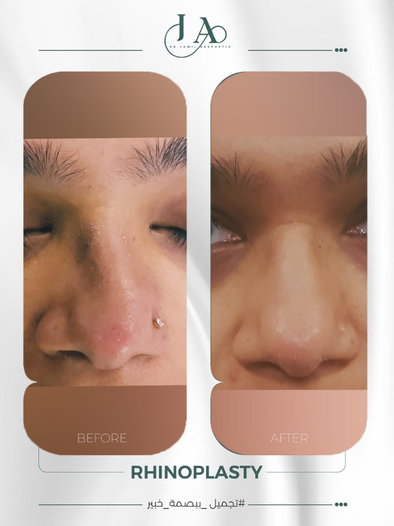 Rhinoplasty — Profile Case 3