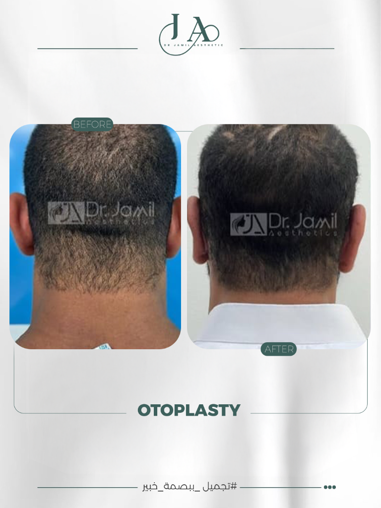 Before & After — Otoplasty — Ear Correction