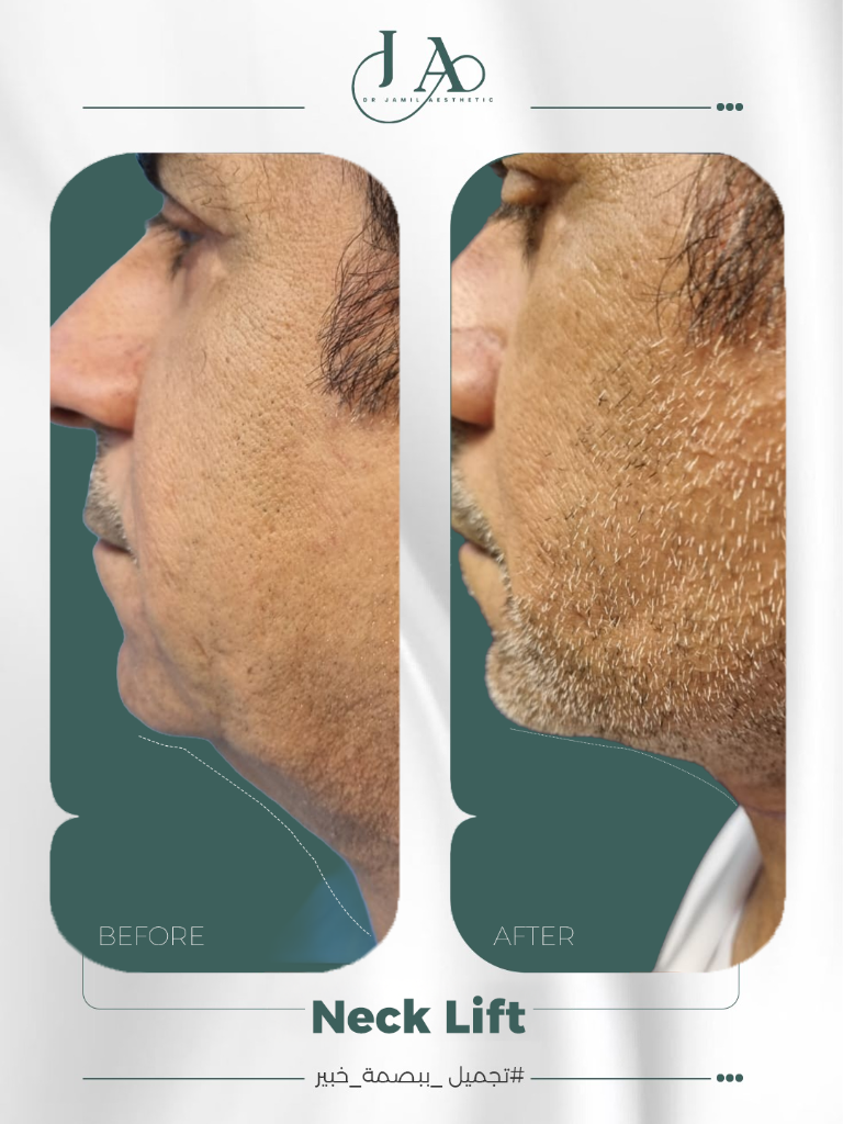 Before & After — Neck Lift — Advanced Correction