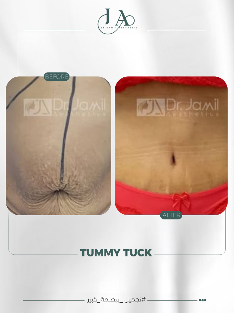 Abdominoplasty — Tummy Tuck