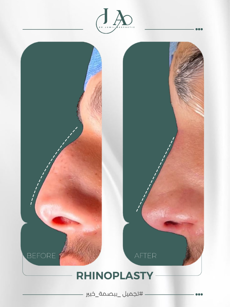 Before & After — Rhinoplasty — Frontal Harmony