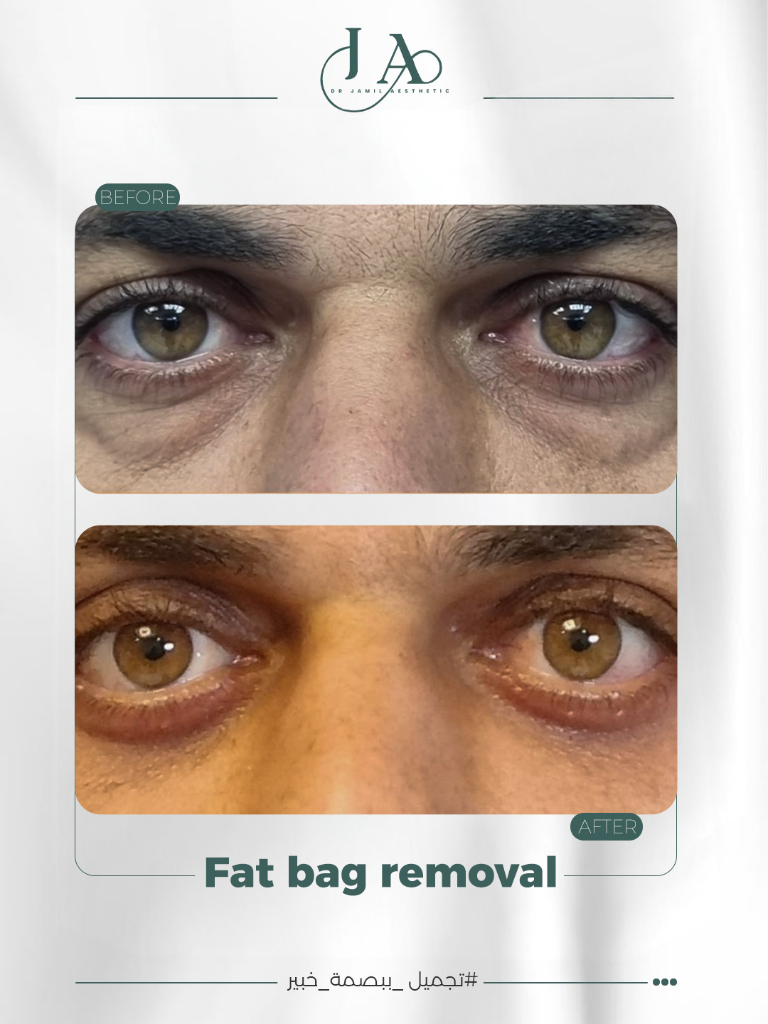 Before & After — Fat Bag Removal — Male Case