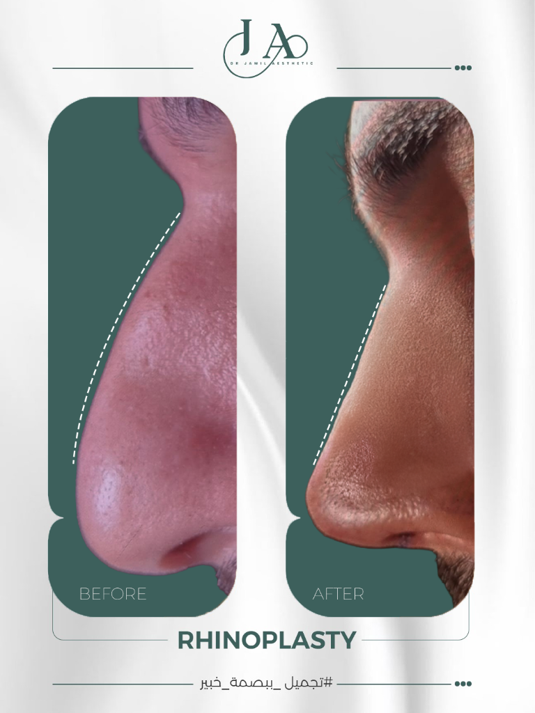 Rhinoplasty — Profile Case 4