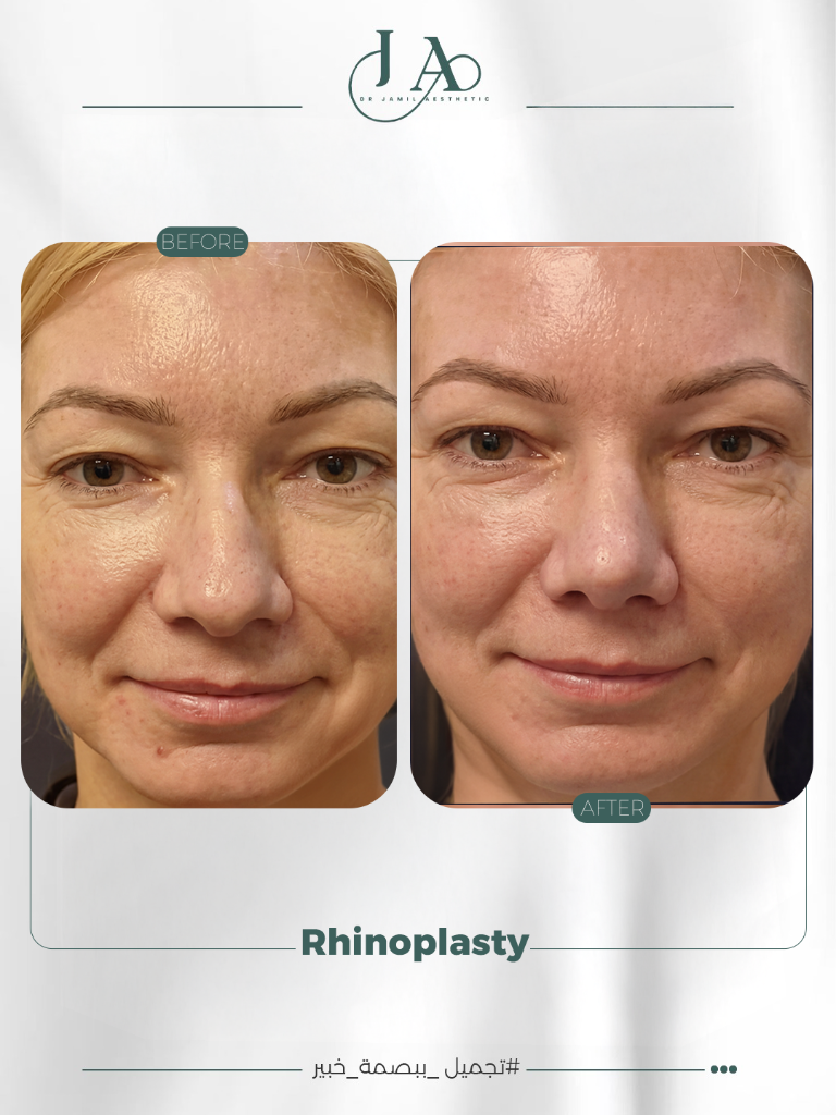Structural Rhinoplasty — Profile Refinement