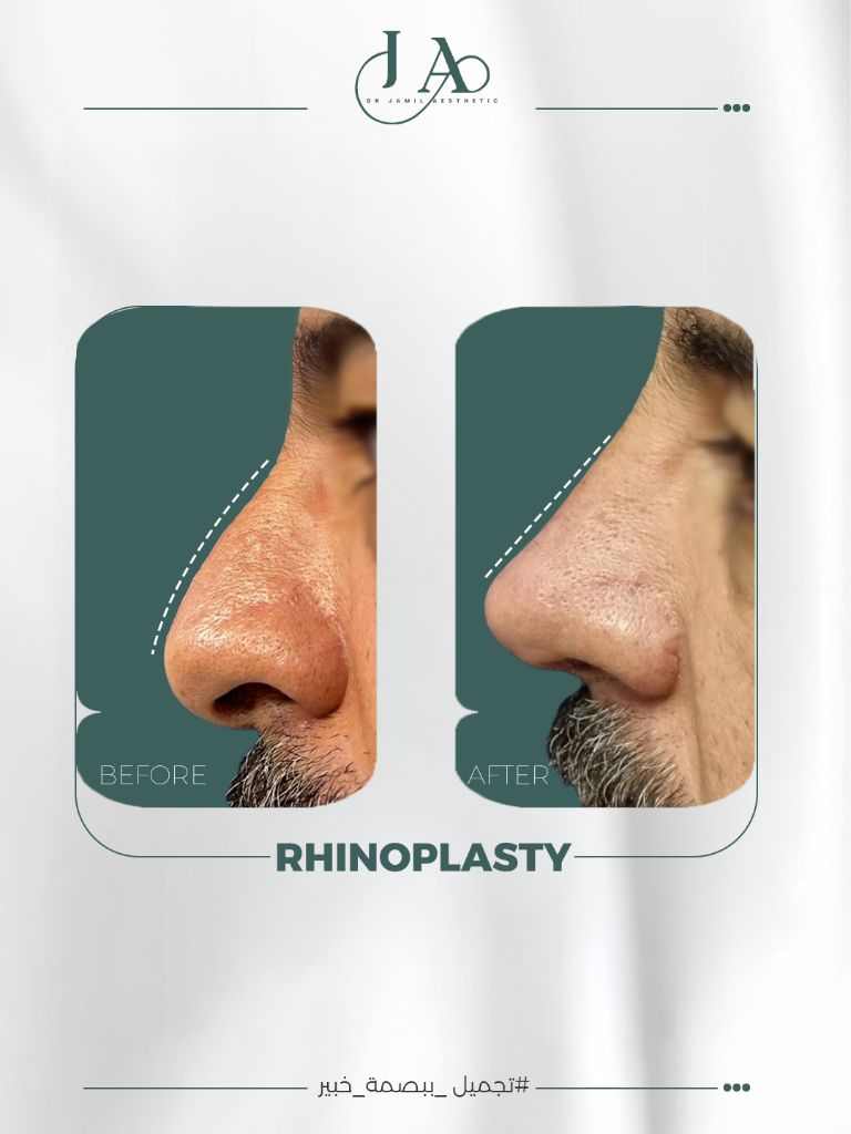 Rhinoplasty — Dorsal & Tip Correction