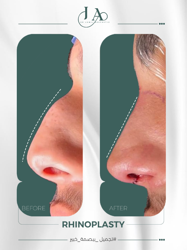 Rhinoplasty — Profile Case 5