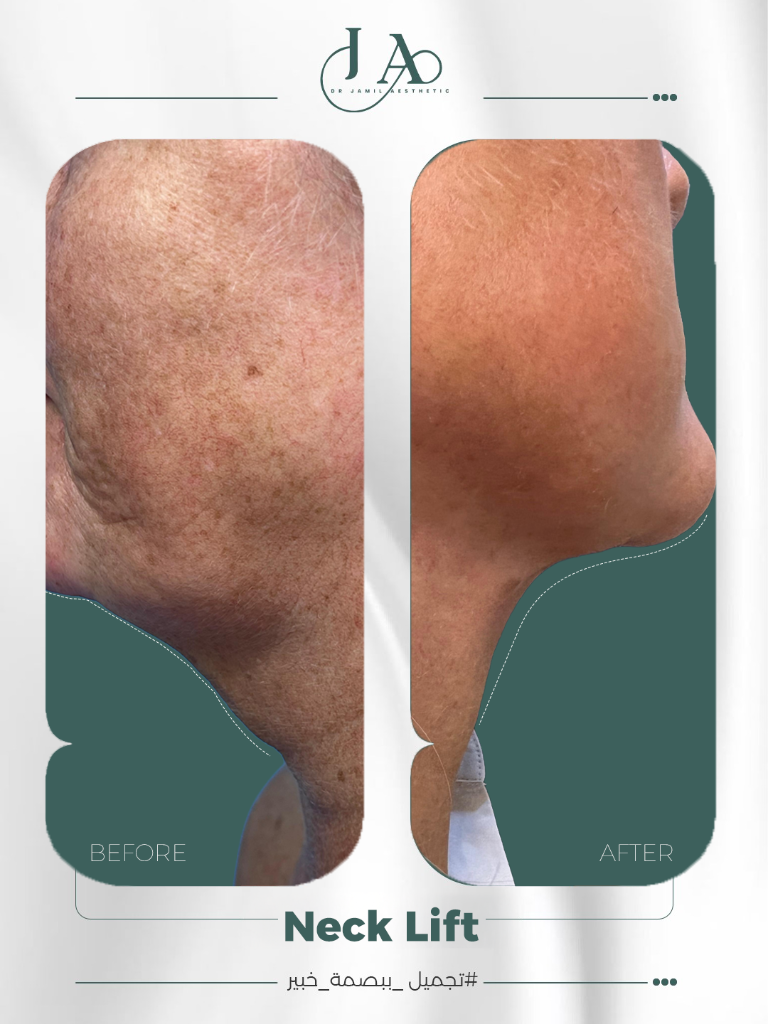 Neck Lift — Cervicomental Angle Restoration