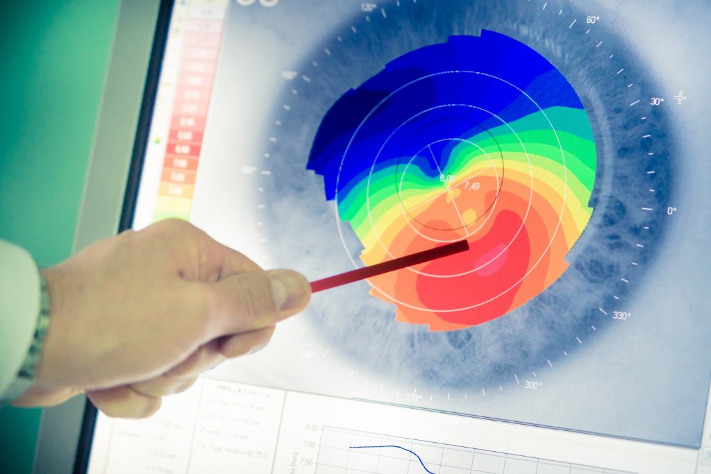 מה זה קרטוקונוס?