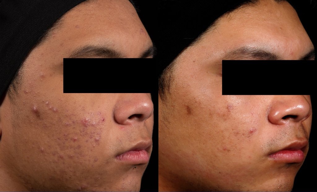 AviClear before and after — Patient 2 showing significant acne reduction