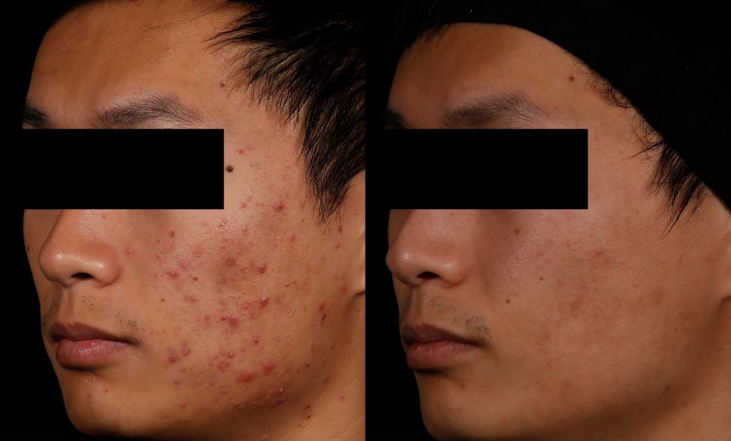 AviClear before and after — Patient 3 showing significant acne reduction