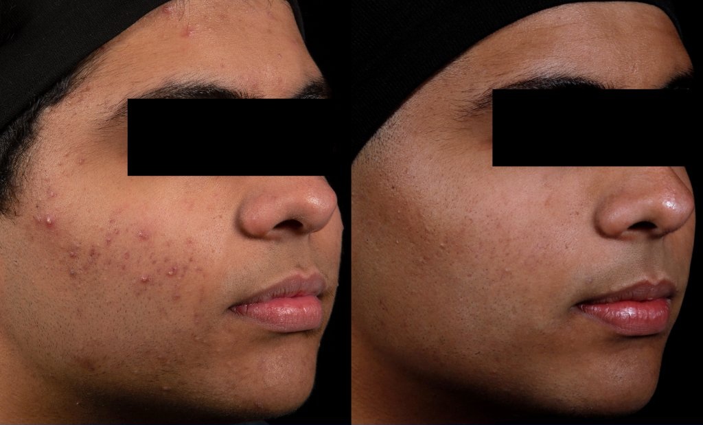 AviClear before and after — Patient 1 showing significant acne reduction