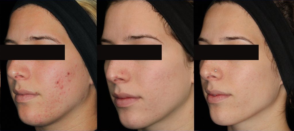 AviClear progression — before, after 6 months, and after 12 months