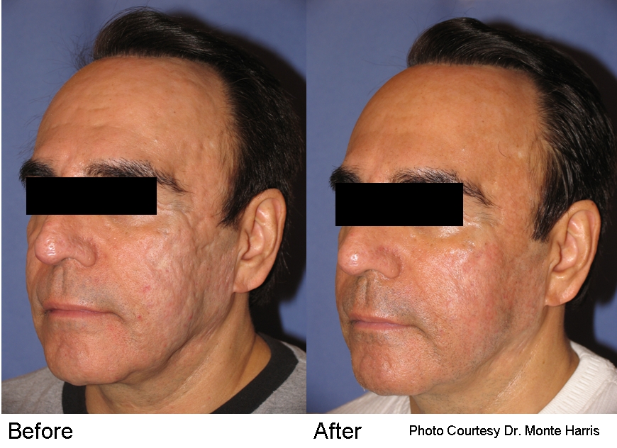 IPL Photofacial before and after