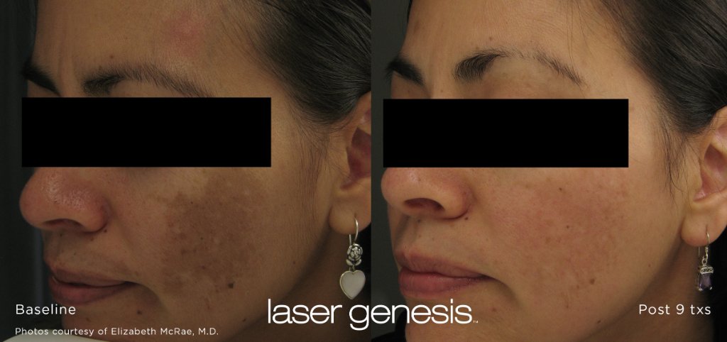 Laser Genesis before and after