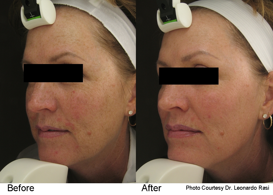 Laser Genesis before and after