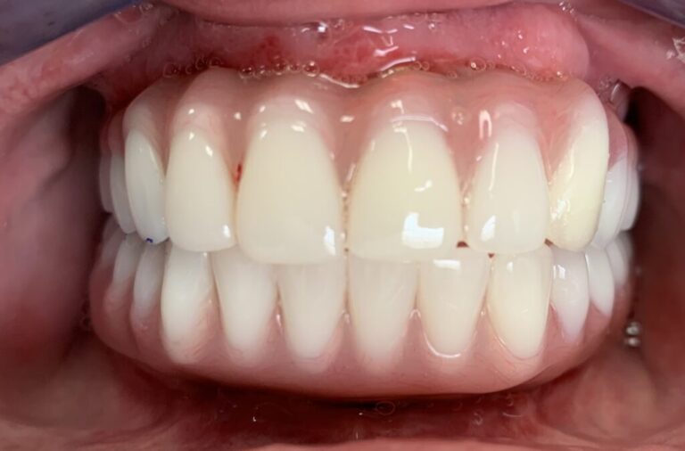 All-on-X Full Mouth Restoration after