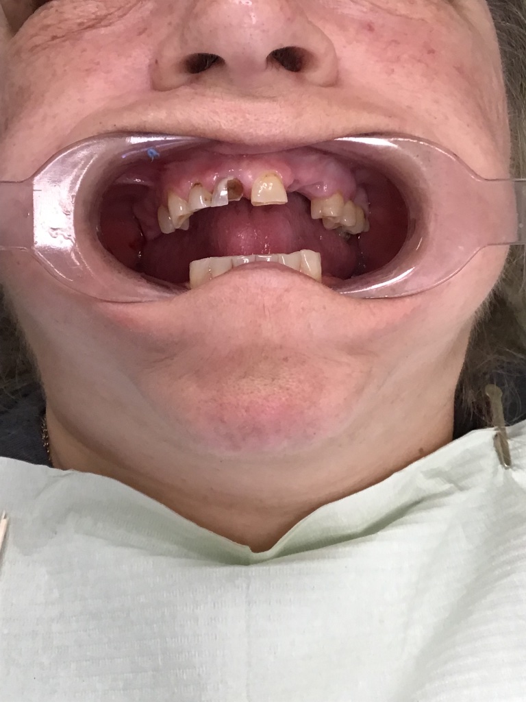 Snap-On Denture – Upper & Lower before