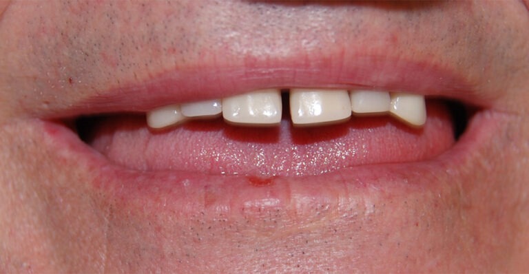Snap-On Dentures with Dental Implants before