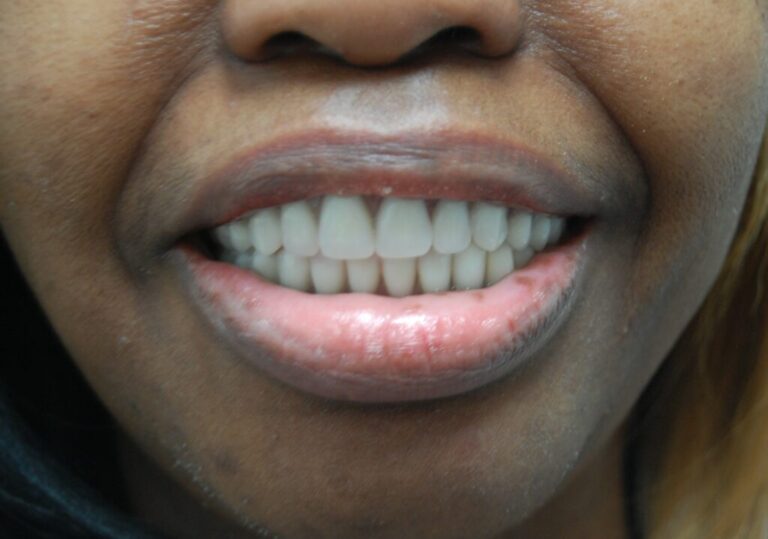 Snap-On Dentures – Upper & Lower after