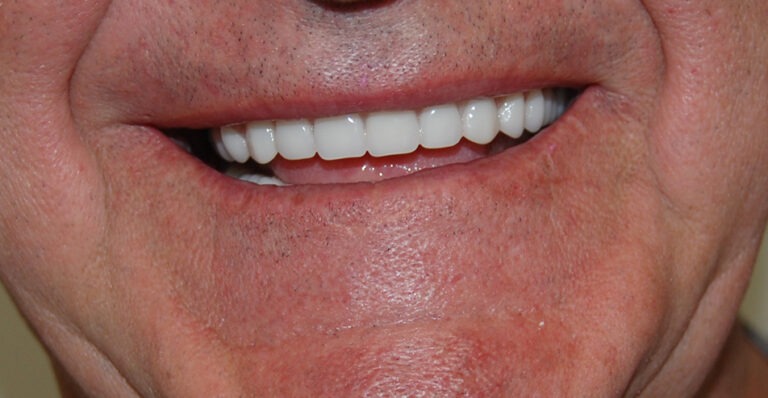 Snap-On Dentures with Dental Implants after