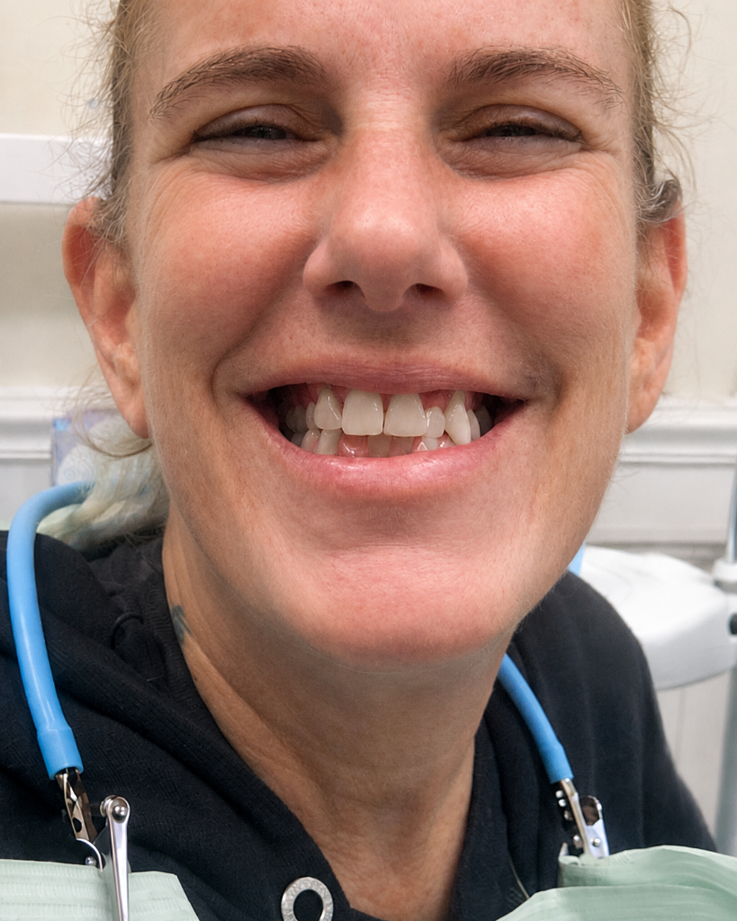 All-on-X – Zirconia Over Titanium Bar before