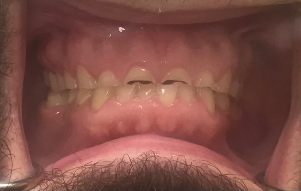 Upper Arch Reconstruction before