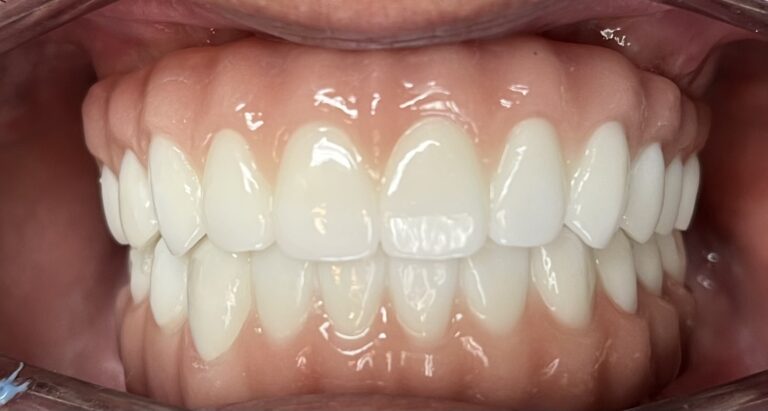 All-on-4 Zirconia Smile Restoration after
