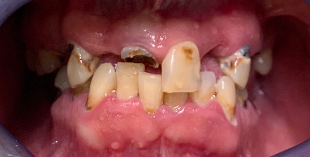 Fixed All-on-X – Upper & Lower before