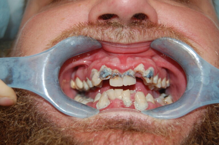 All-on-X Full Mouth Restoration before