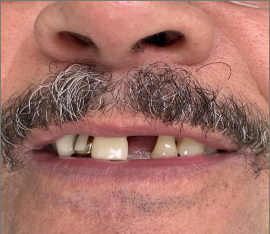 All-on-4 Zirconia Smile Restoration before