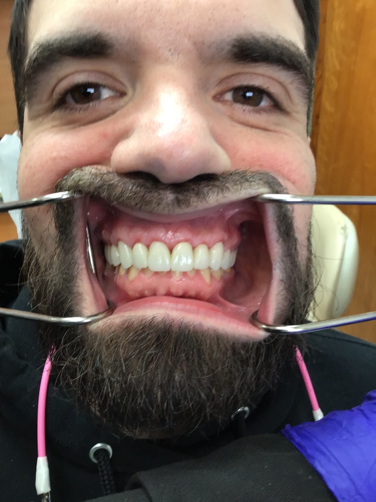 Upper Arch Reconstruction after