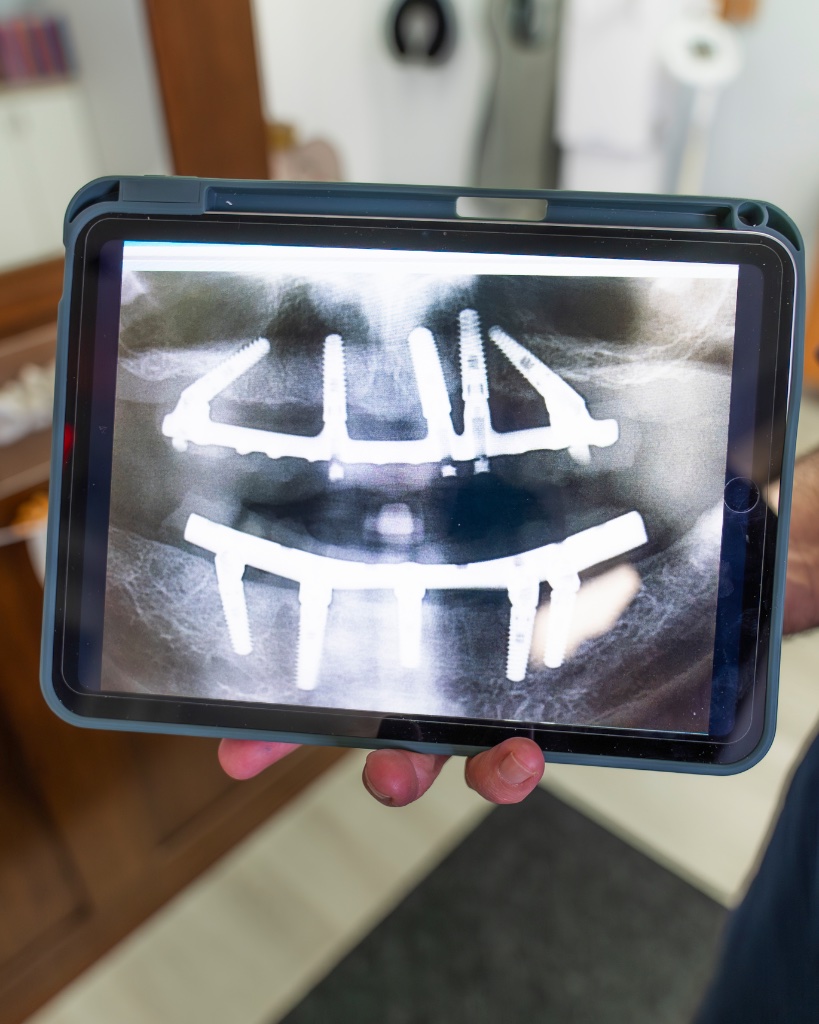 Implant Dentistry