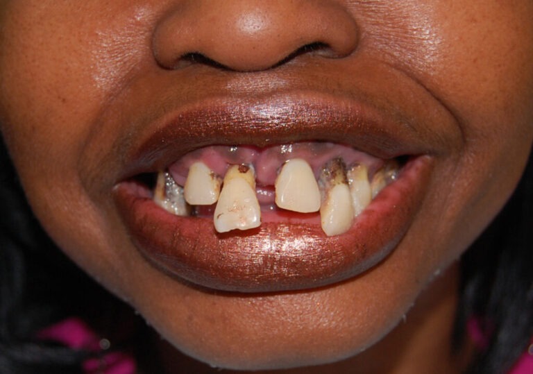 Snap-On Dentures – Upper & Lower before