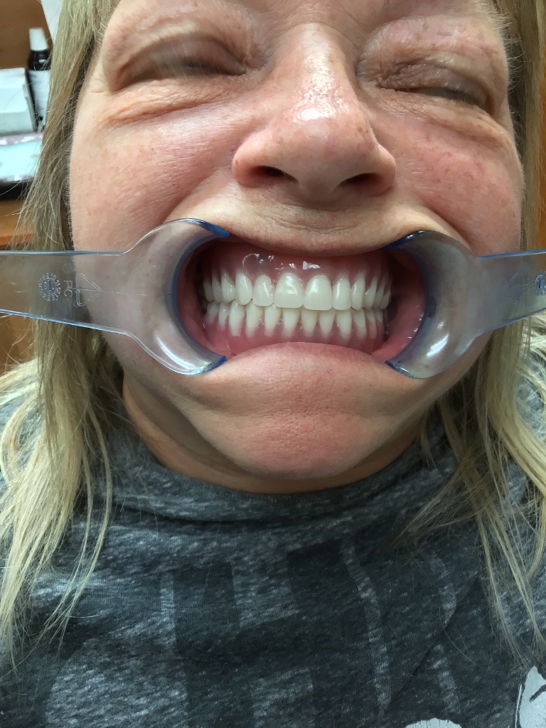 Snap-On Denture – Upper & Lower after