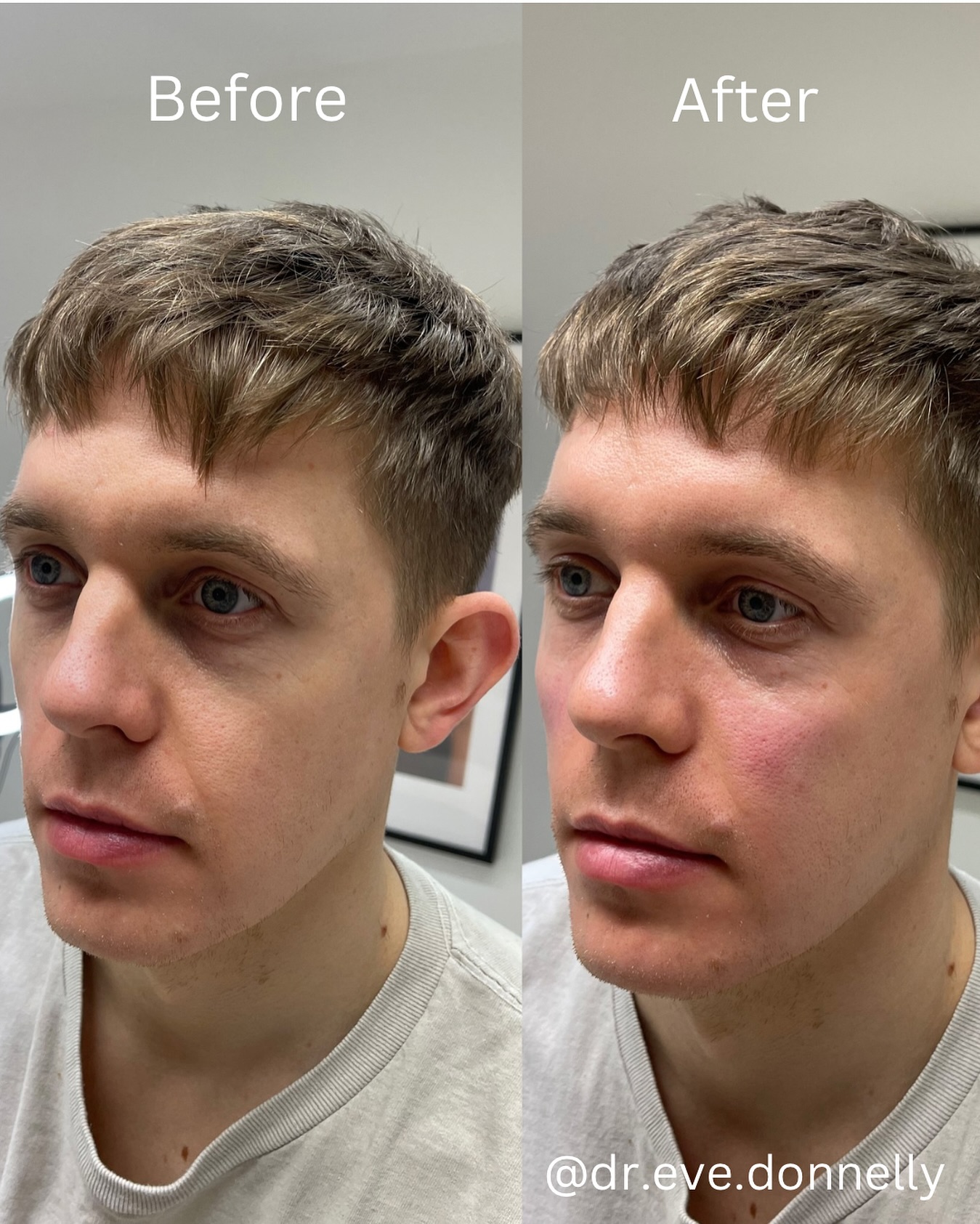 After — Mid-face dermal filler before and after — jowl smoothing at Skiin Clinic Manchester