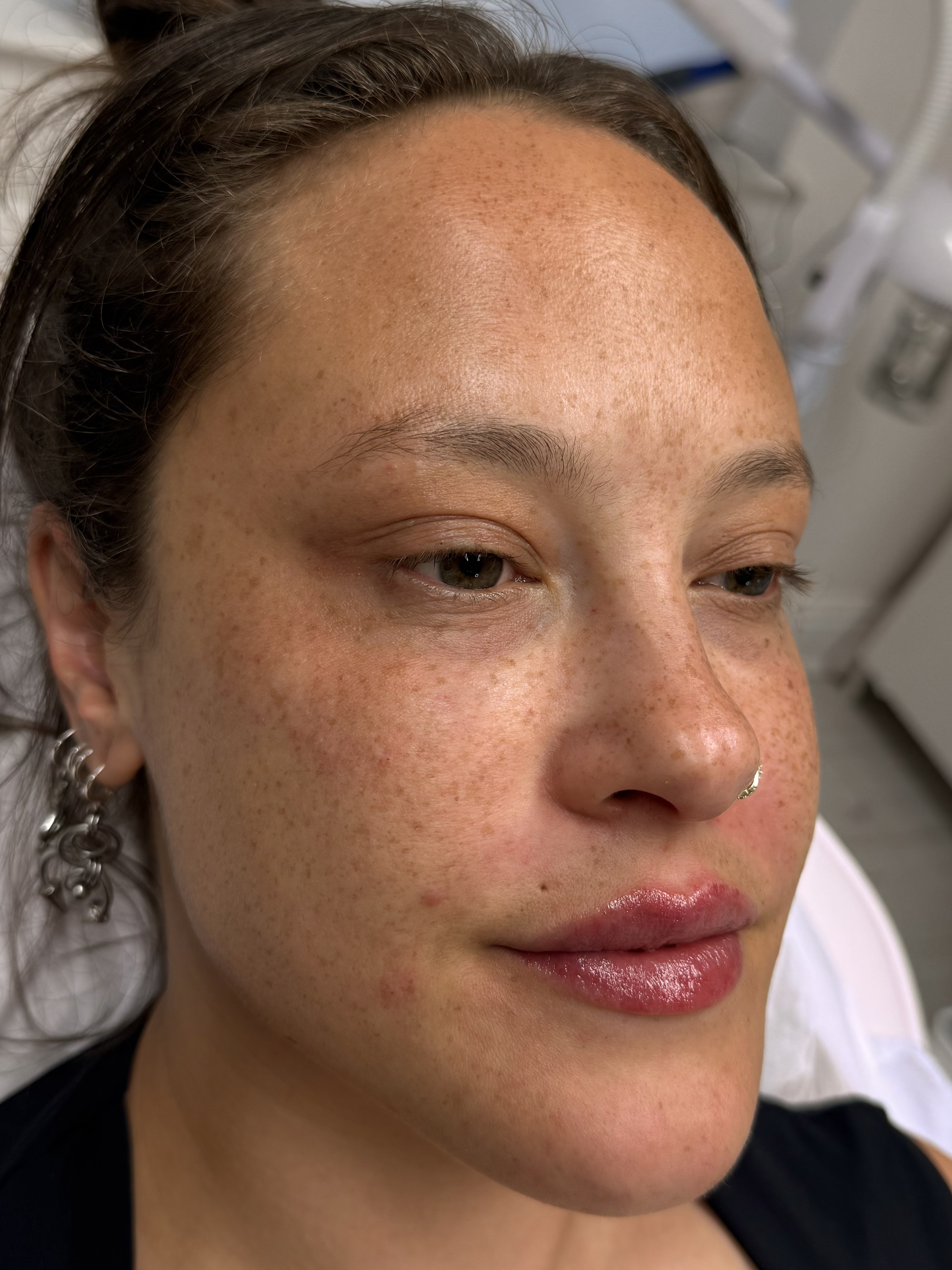 After — Dermal filler full face rejuvenation before and after in Manchester