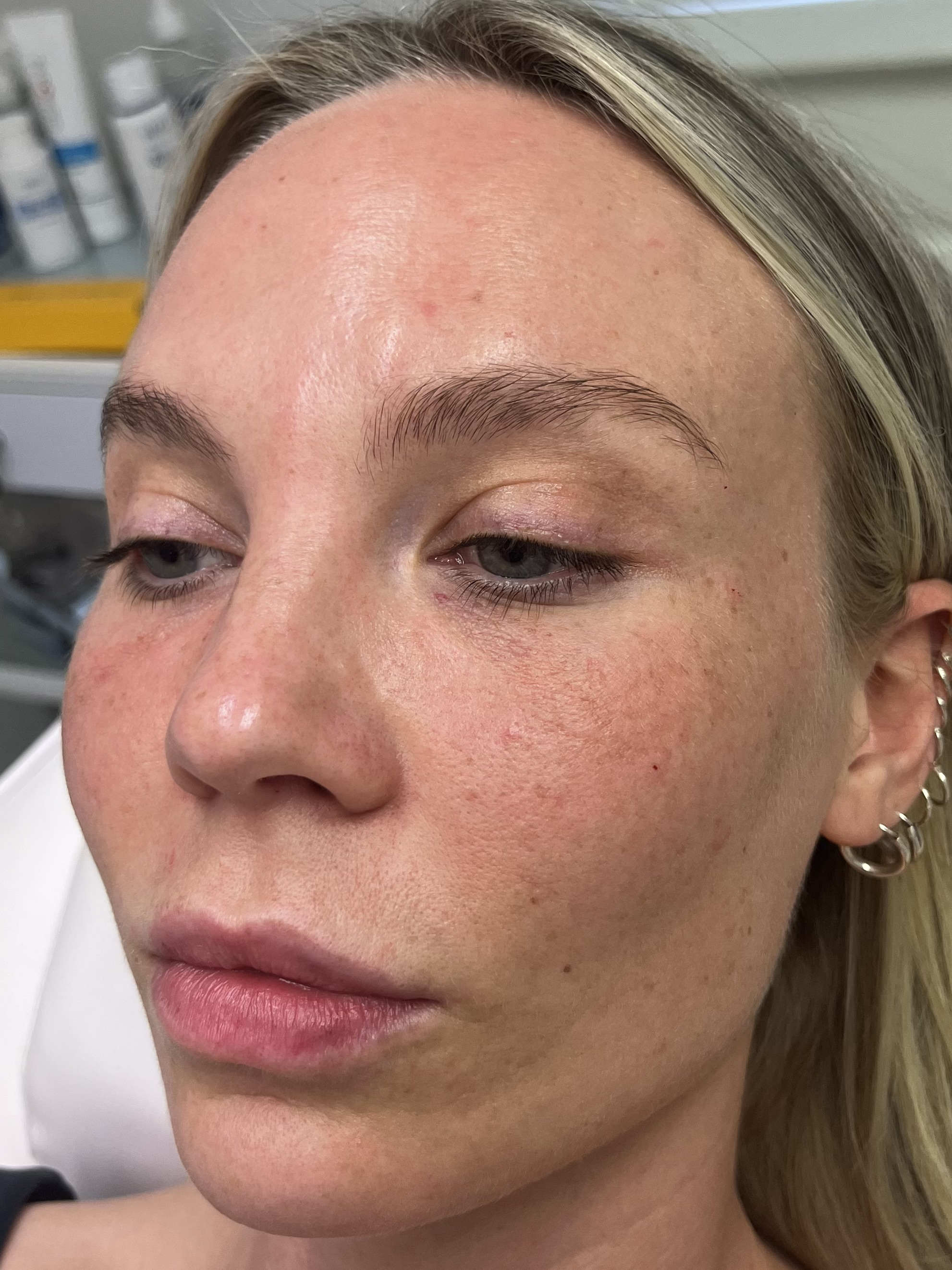 Before — Full face rejuvenation before and after — anti-wrinkle treatment and dermal filler at Skiin Clinic Manchester