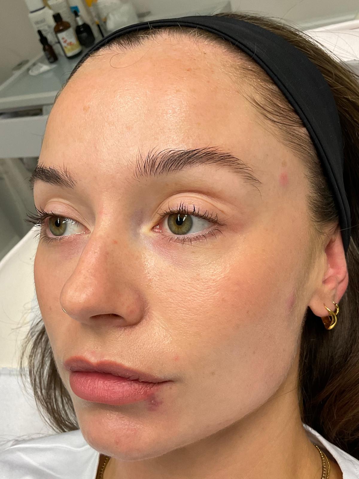 After — Polynucleotides under-eye treatment before and after at Skiin Clinic Manchester