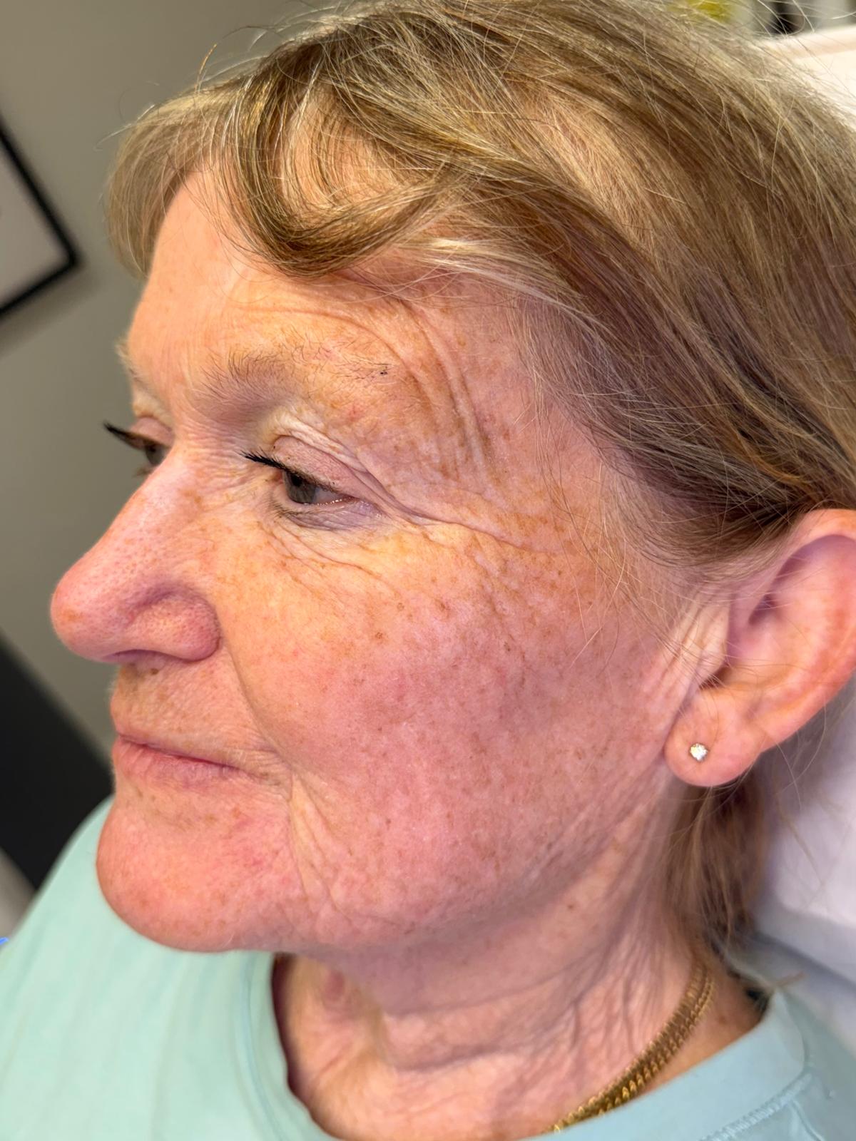 Before — LaseMD Ultra with RF microneedling before and after at Skiin Clinic Manchester