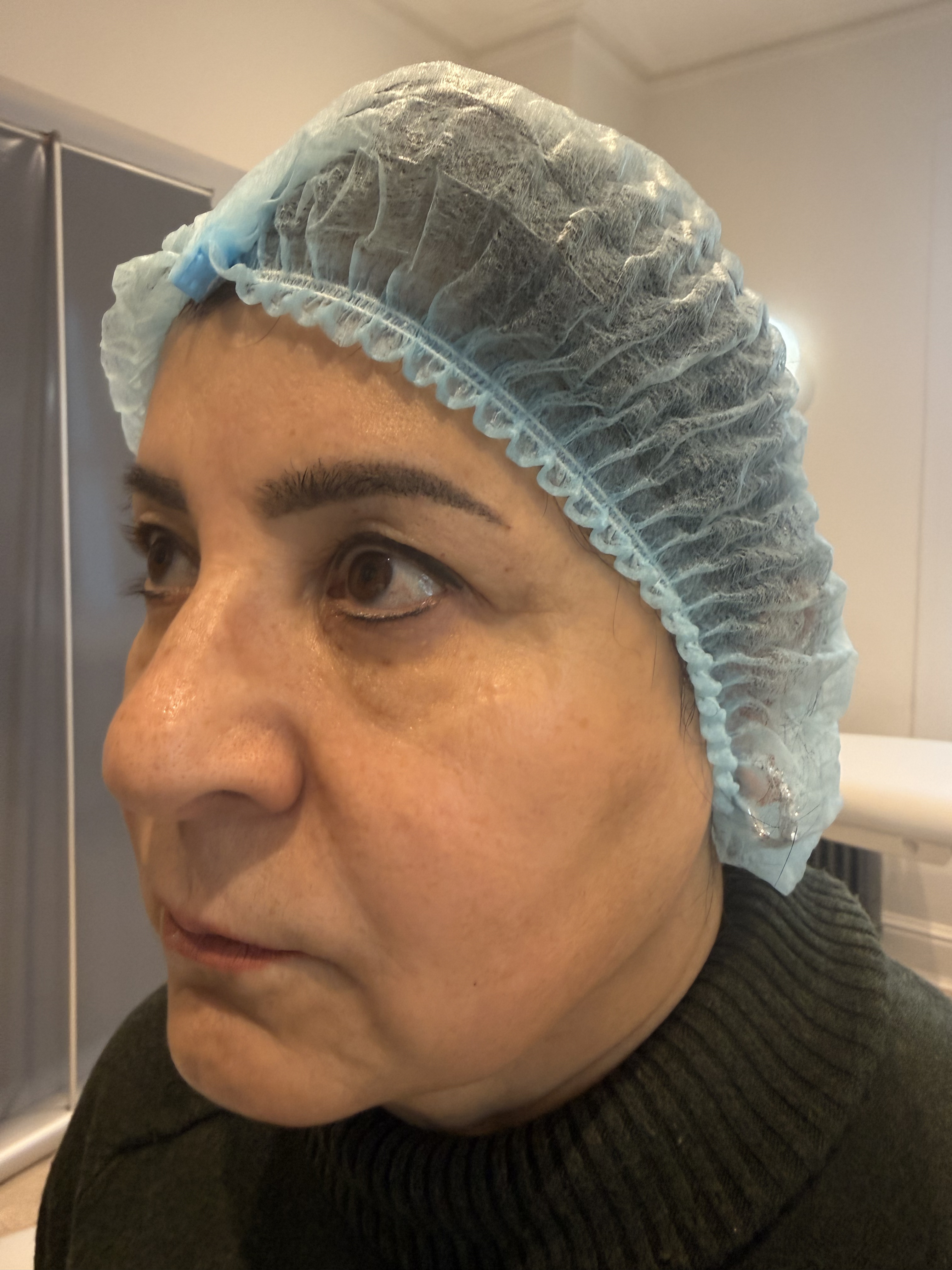 Before — Radiesse jawline and profile definition before and after at Skiin Clinic Manchester